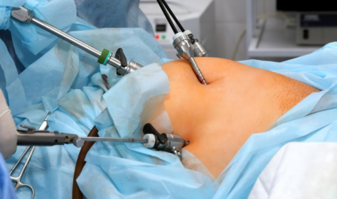 Hernia Repairs Demystified: Understanding Modern Surgical Options